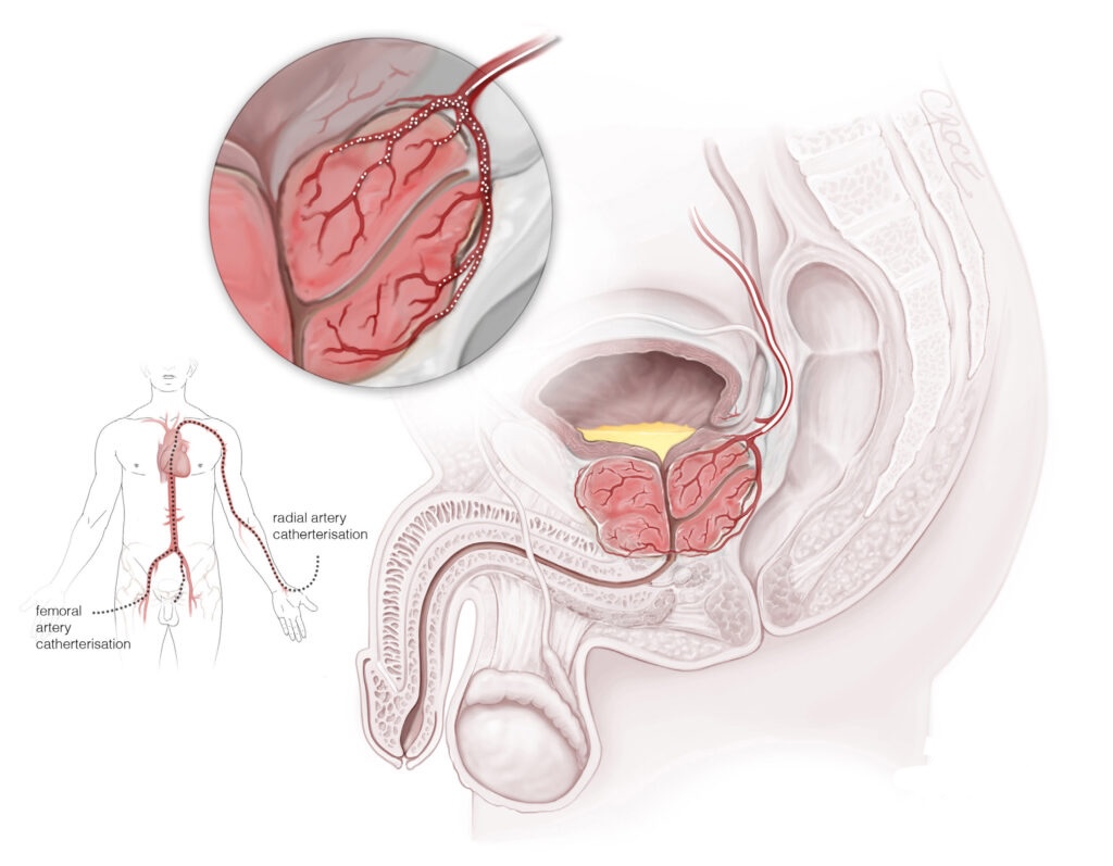 Prostate Artery Embolization