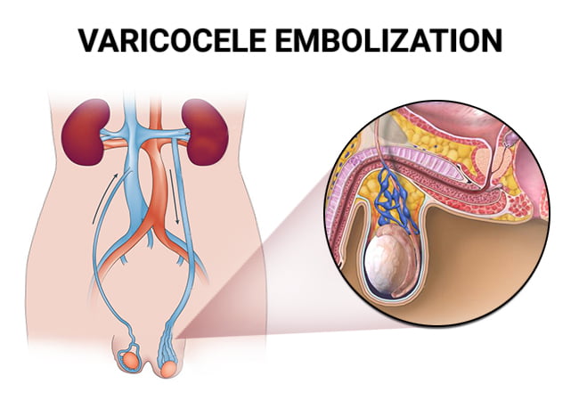 Varicose Veins Ablation