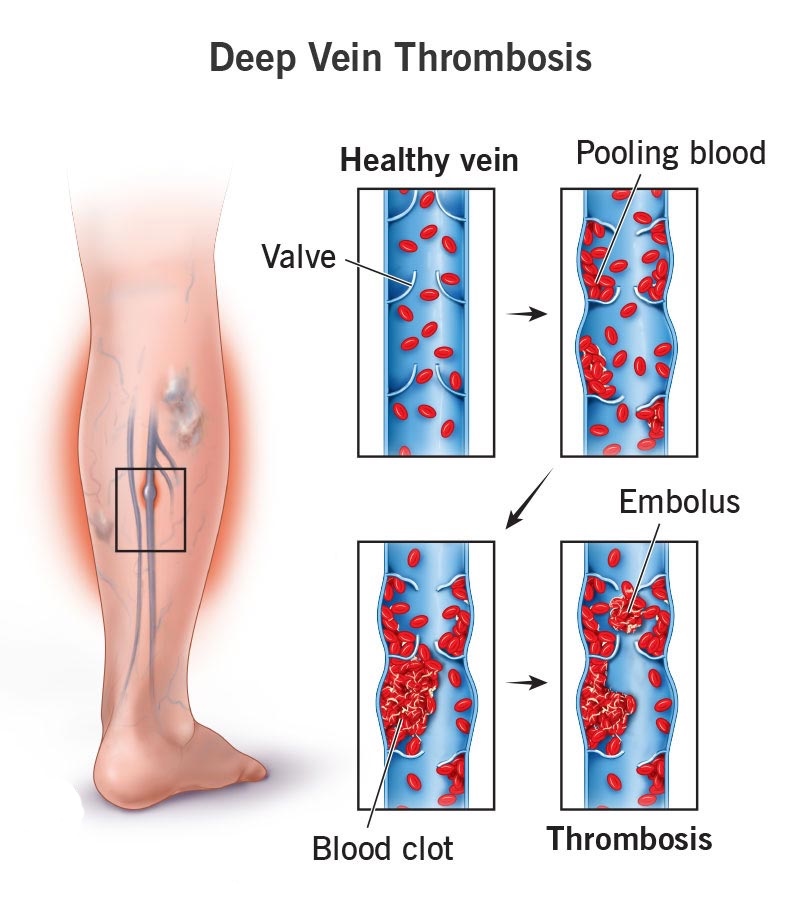 Venous Thromboembolism
