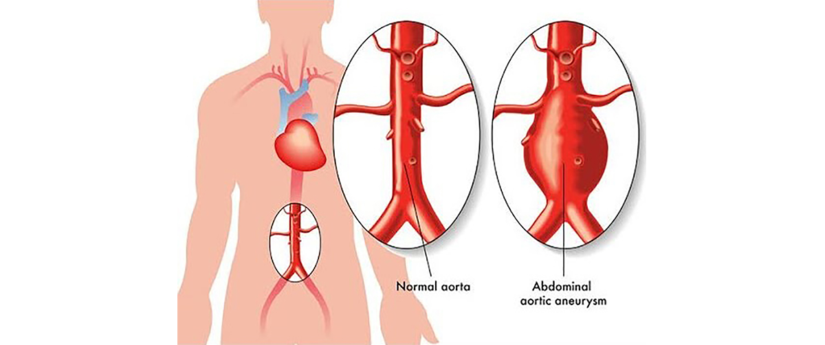Endovascular Aortic Interventions