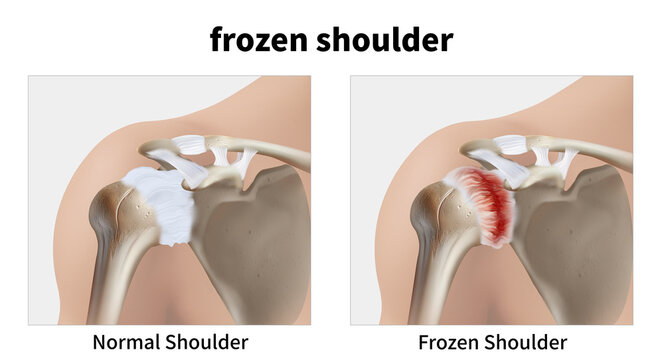 Frozen Shoulder